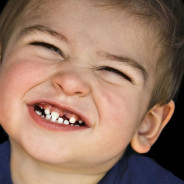 TEETH GRINDING IN CHILDREN